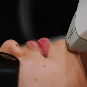Three Laser Hair-Removal Sessions at SpaDerma Wicker Park(Up to 83% Off)
