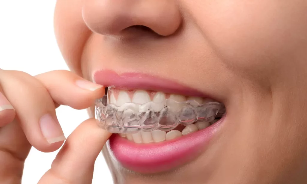 Transform Your Smile w/Invisalign Consultation, Itero Scan, Before-After Photos & Treatment Plan (Up to 45% Off)